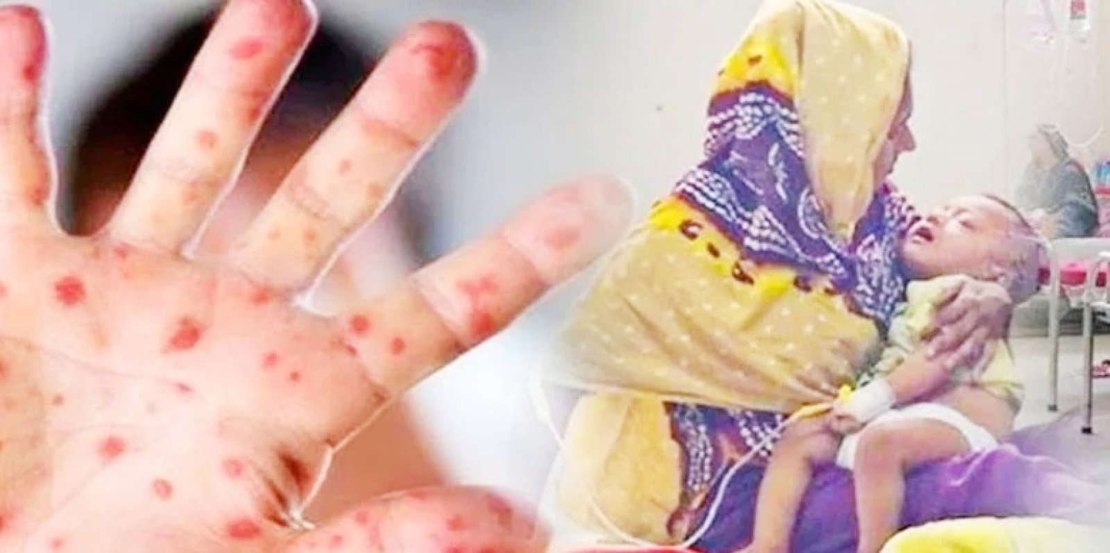 হাম রোগে আরো ৭ শিশুর মৃত্যু